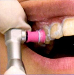 歯の表面をクリーニング