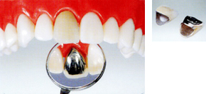 硬質レジン前装冠