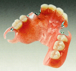 ノンクラスプデンチャー