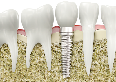 インプラント治療