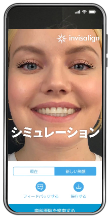 インビザライン スマイルビュー