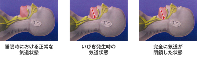 睡眠時無呼吸症候群とは