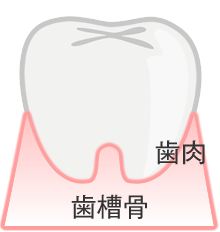 歯周病の進行