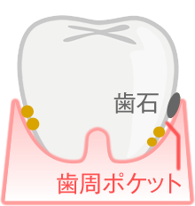 歯周病の進行