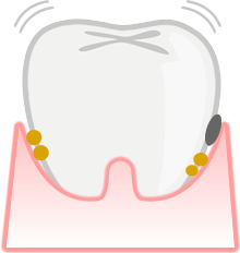 歯周病の進行