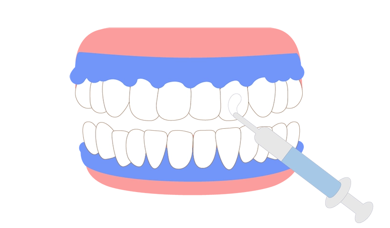 ホワイトニングジェル塗布
